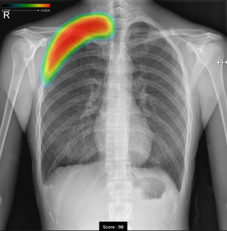 CXR-AIDで撮影した気胸