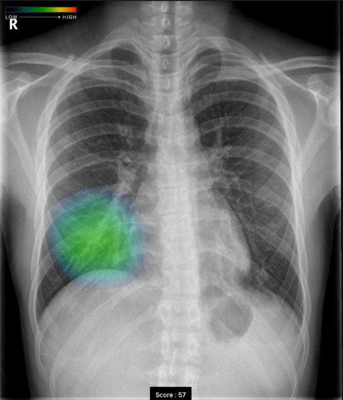 CXR-AIDで撮影した浸潤影