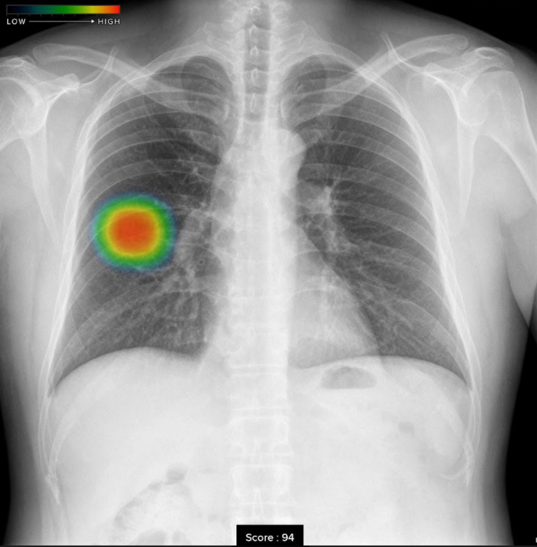CXR-AIDで撮影した結節・腫瘤影
